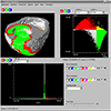 WEAVE in D. Gresh, B. Rogowitz, R. Winslow, D. Scollan, and C. Yung 2000: WEAVE: A system for visually linking 3D and statistical visualizations applied to cardiac simulation and measurement data